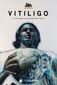 Vitiligo